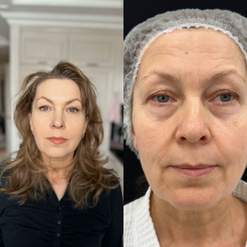 Before and after result 2
