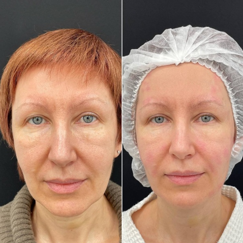 Before and after result 1