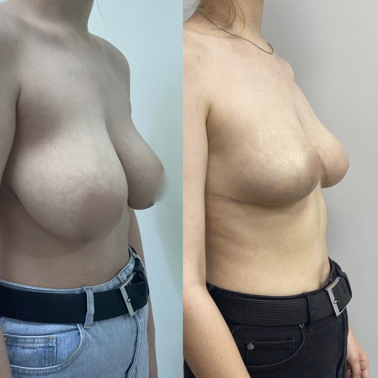Before and after photo 4