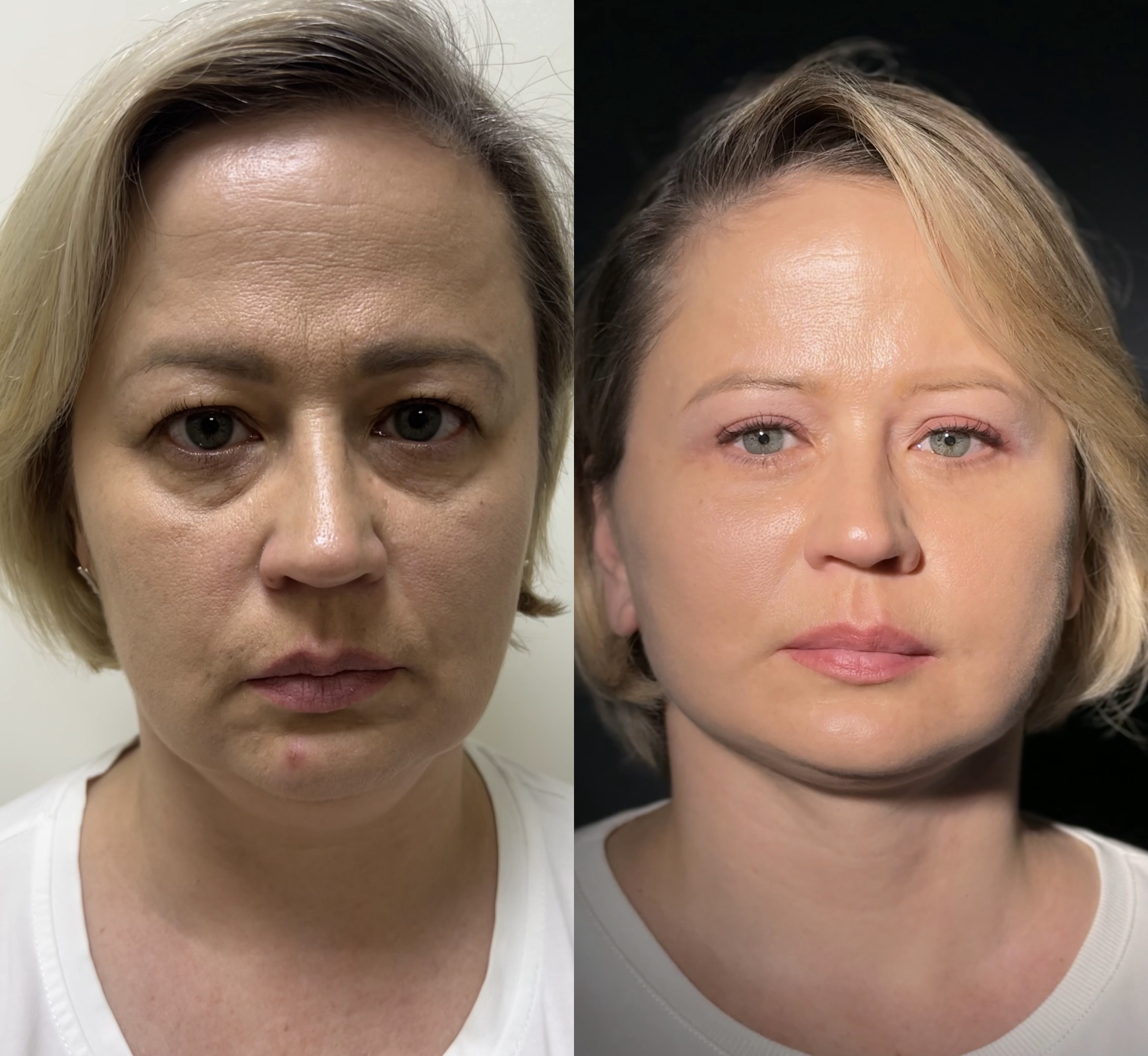 Фейслифтинг для лица